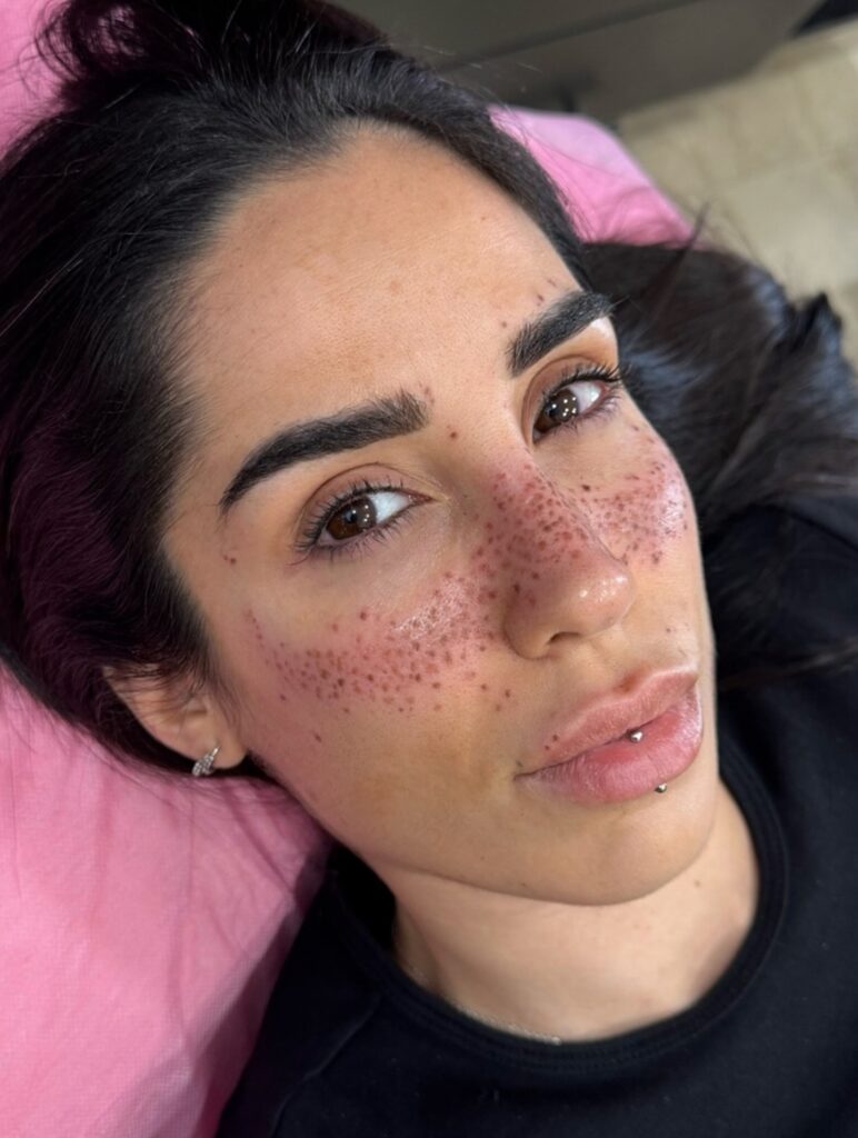 Dark Freckles Tattoo With Striking Coverage