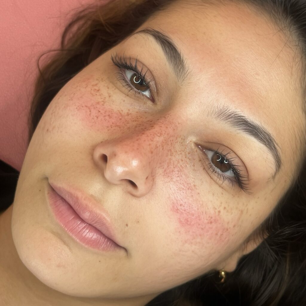 Fully Healed Freckles Tattoo With Natural Blend